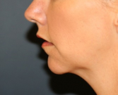 Feel Beautiful - Chin Implant 206 - Before Photo